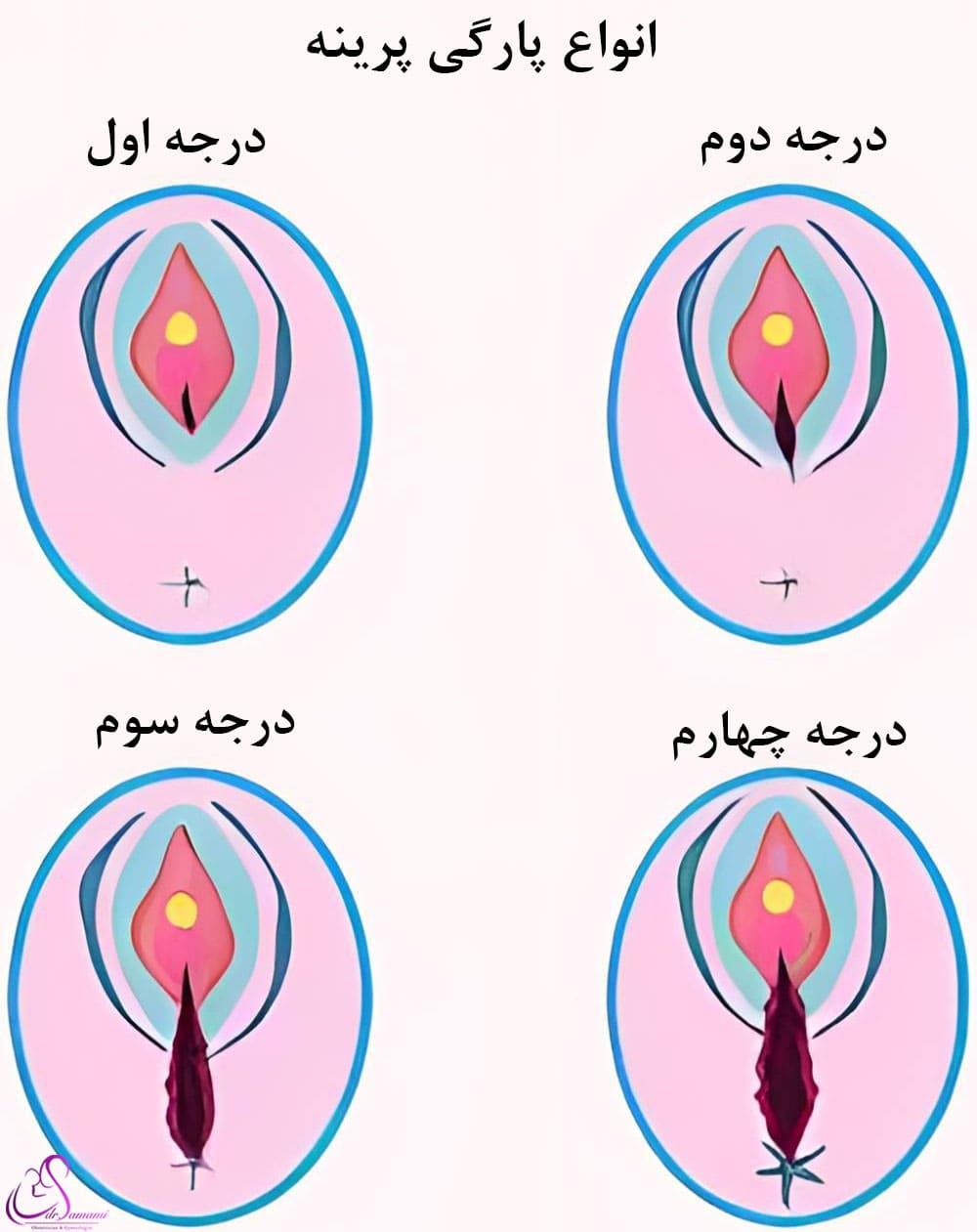 درجات آسیب دیدن پرینه