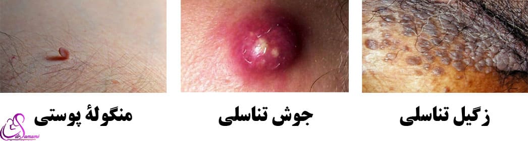 تفاوت زگیل تناسلی زنان با منگوله‌های پوستی و جوش