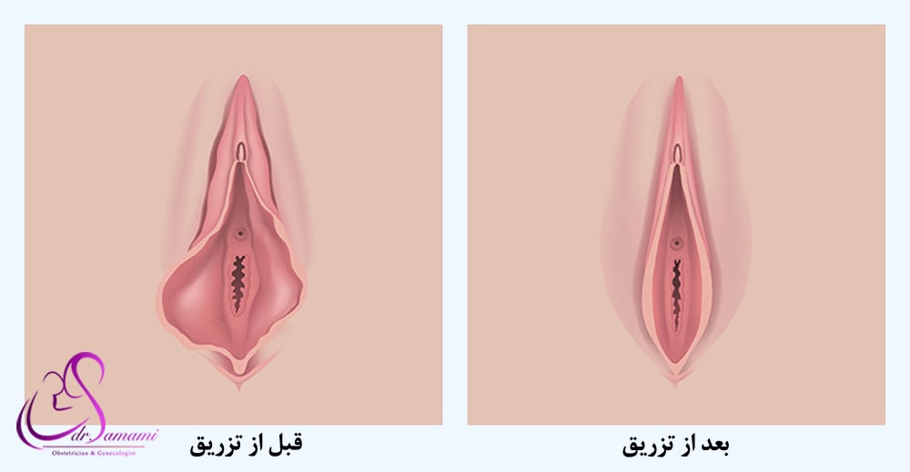 مراقبت های بعد از تزریق ژل به بیکینی+هزینه تزریق ژل به بیکینی+تنگ کننده بیکینی