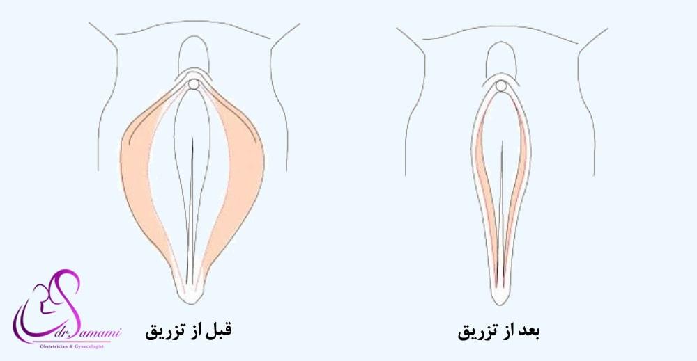 مراقبت های بعد از تزریق ژل به بیکینی+هزینه تزریق ژل به بیکینی+تنگ کننده بیکینی