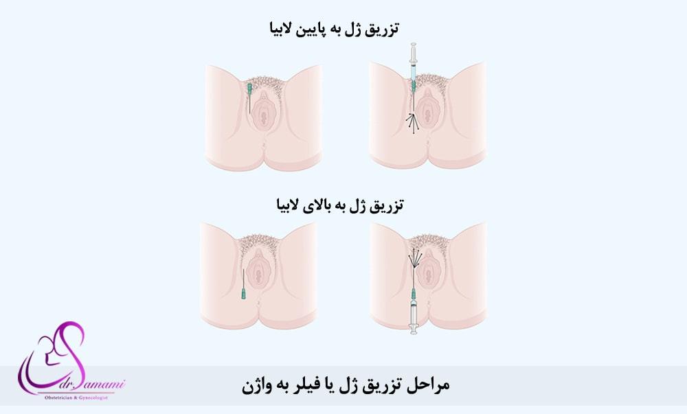 تزریق ژل به لابیا