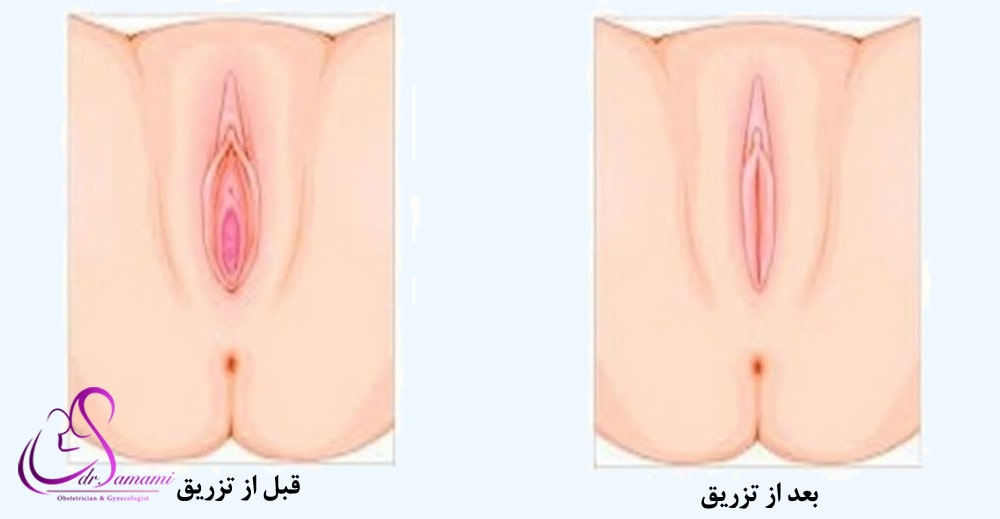 تغییر ظاهر واژن با تزریق ژل یا فیلر