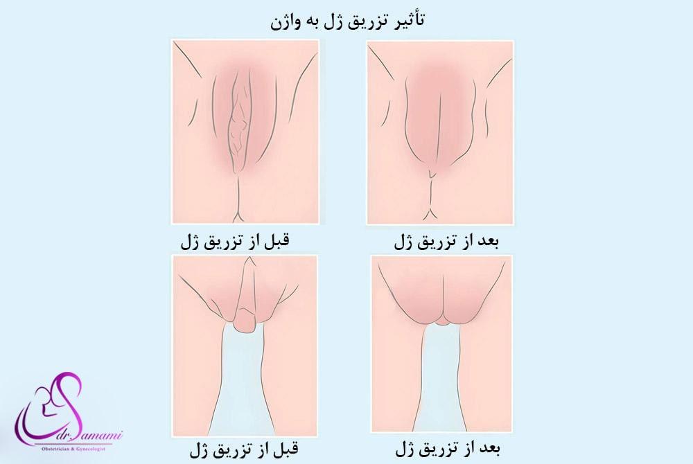 بهترین معجون لاغری شکم و پهلو + نحوه تزریق ژل و چربی به بیکینی