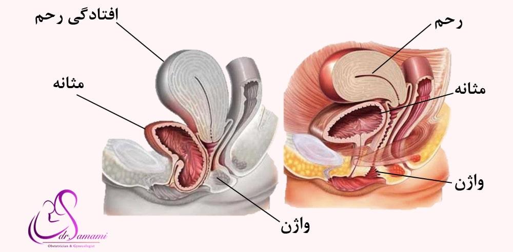 جراحی افتادگی مثانه