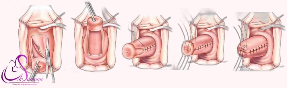 جراحی انسدادی (Oblitrative)