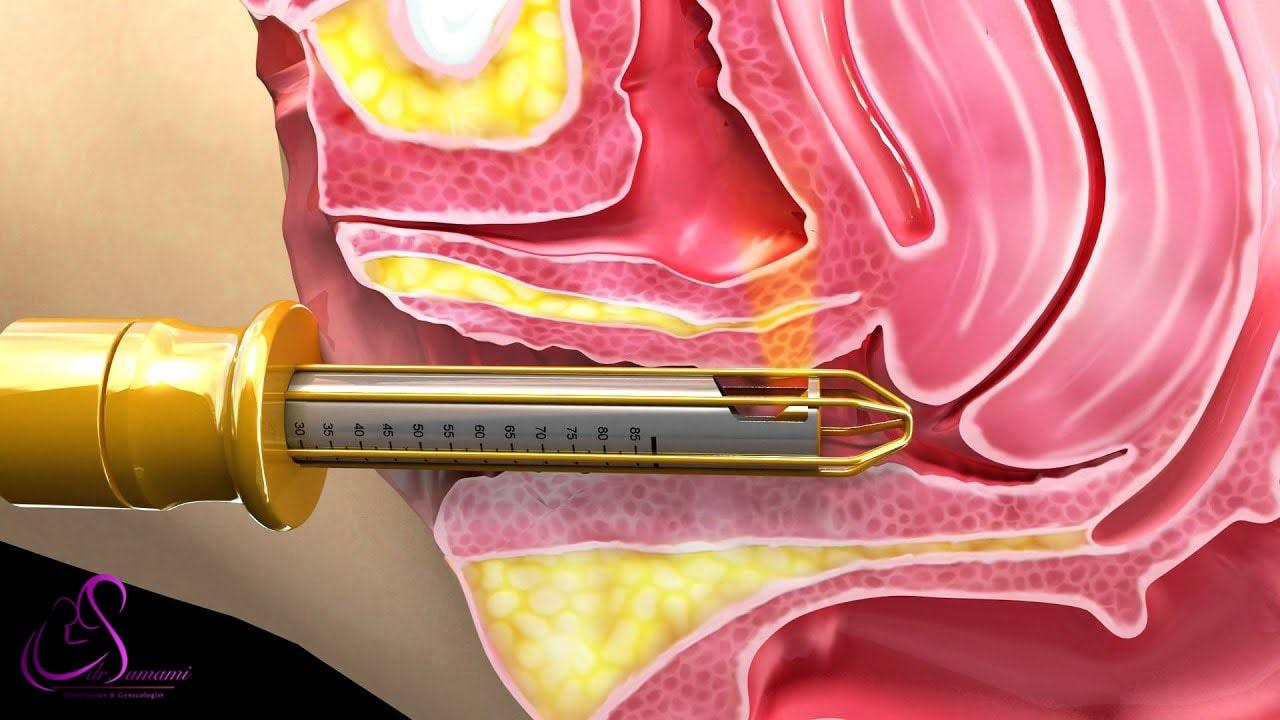 چرا لیزر به درمان بی‌اختیاری ادرار کمک می‌کند؟ 