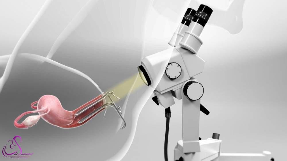 کولپوسکوپی