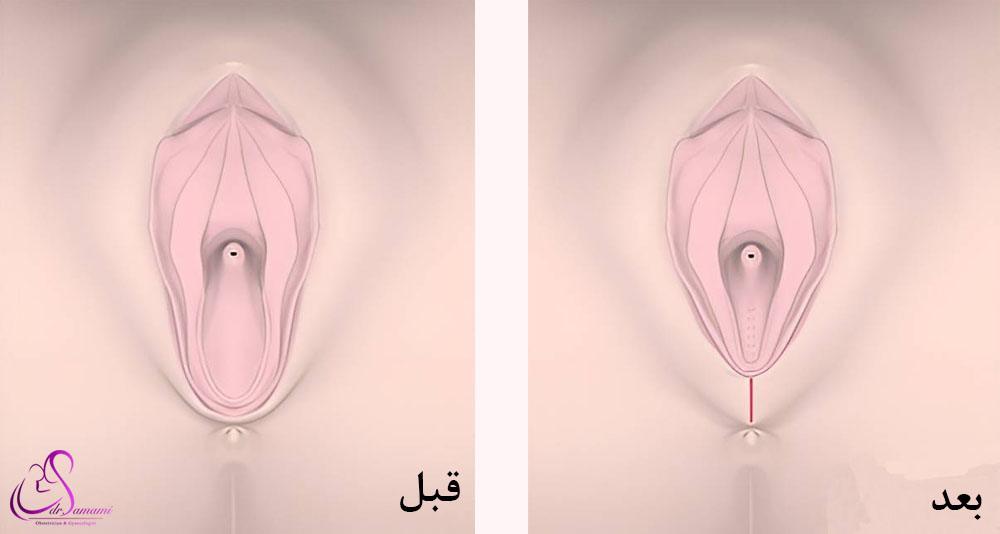 دلایل آسیب دیدن پرینه