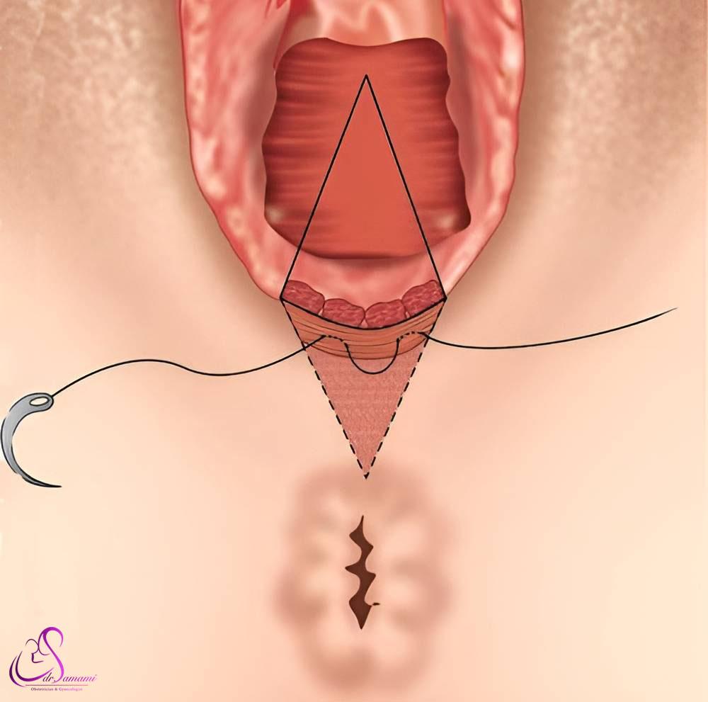 پرینورافی چطور انجام می شود؟