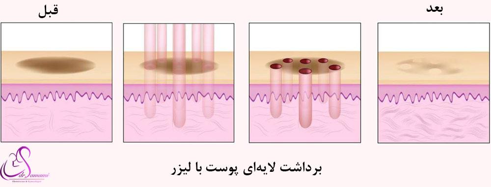 عکس قبل و بعد لیزر سفید کننده واژن+لیزر مونالیزا