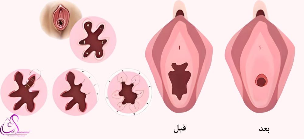 سوالات درباره ترميم بكارت هایمن