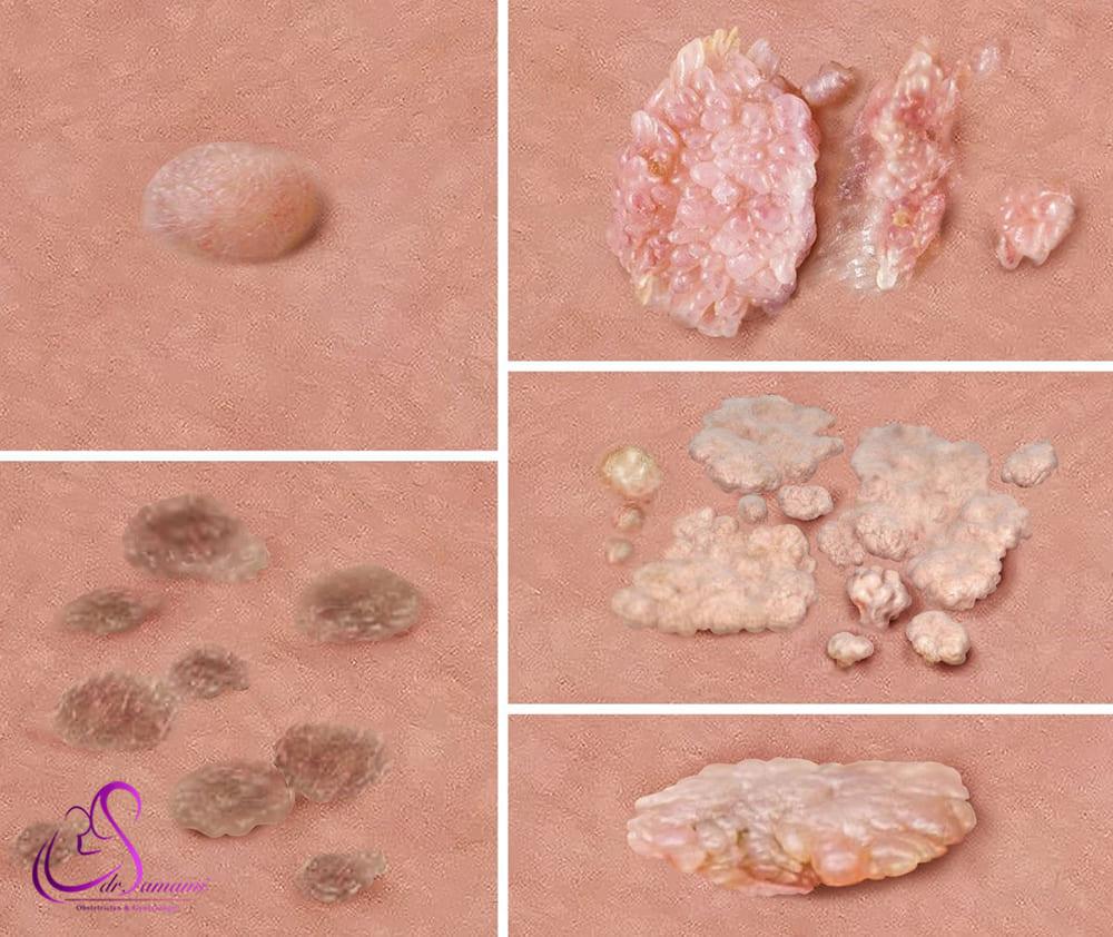 شکل ظاهری زگیل تناسلی