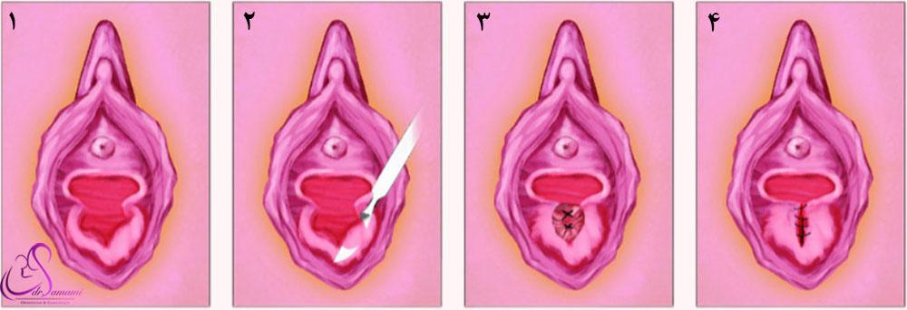 کاشت پرده بکارت