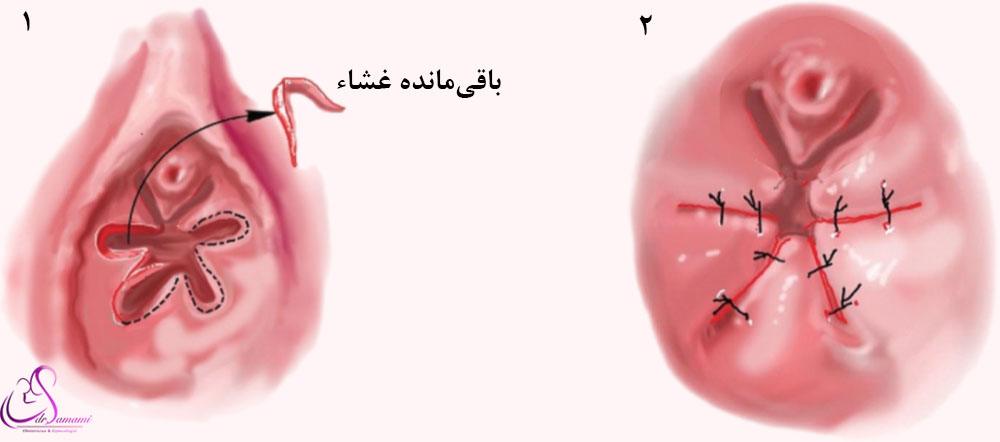 دوخت پرده بکارت