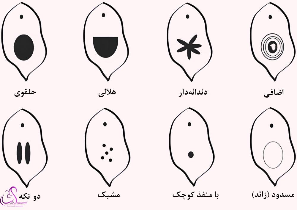 انواع پرده بکارت