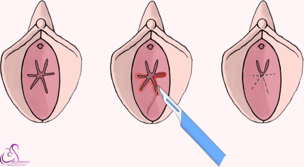 ترمیم بکارت