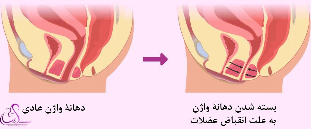 درمان واژینیسموس