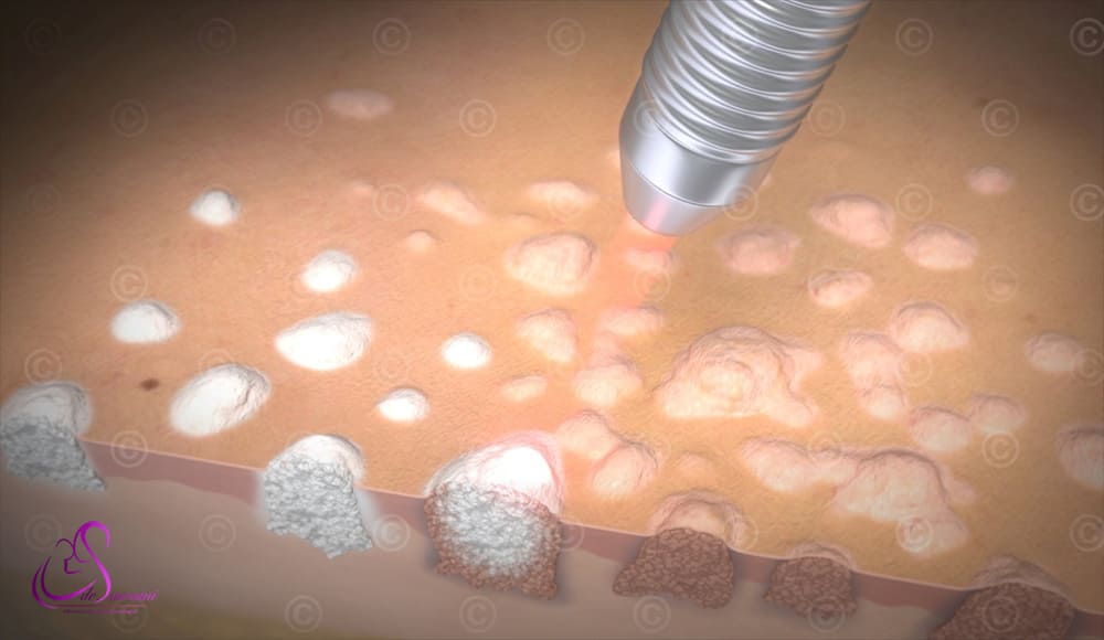 تبخیر زگیل تناسلی با لیزر