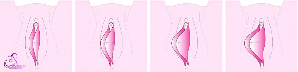 تشخیص بزرگ شدن لابیا 