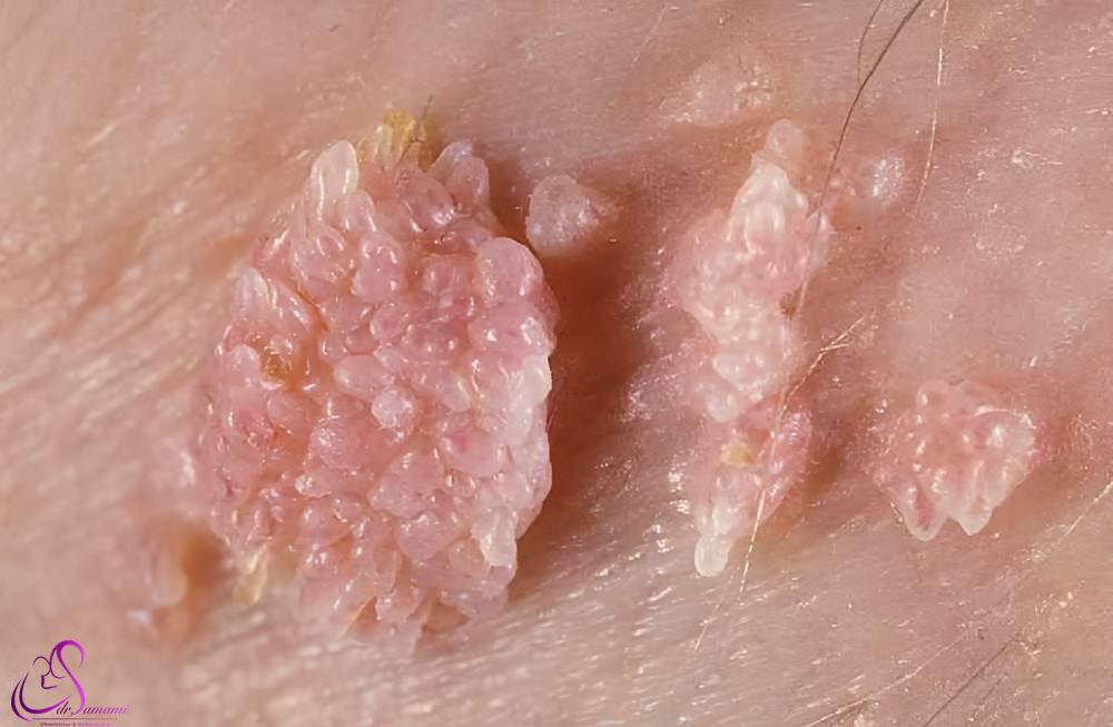 زگیل تناسلی لابیا