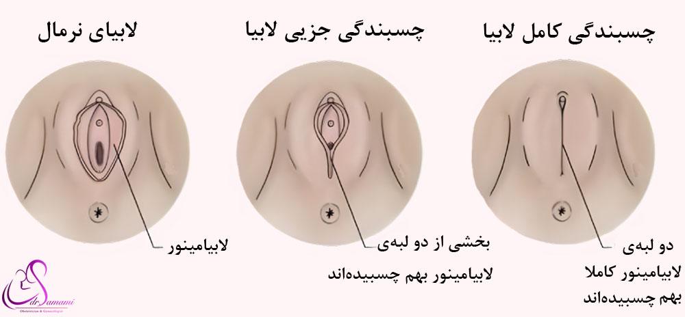 لابیال فیوژن