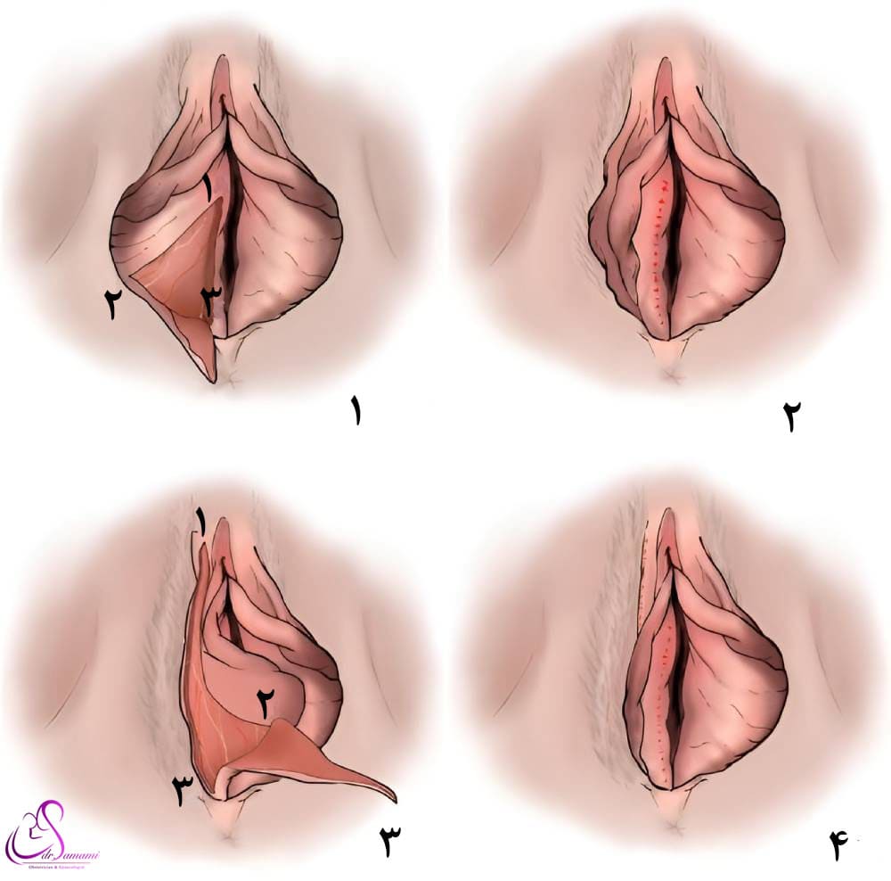 لابیاپلاستی