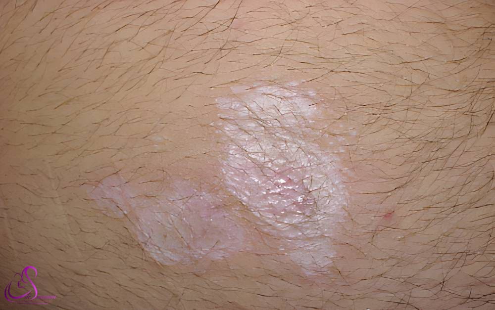 لیکن اسکلروزوس لابیا