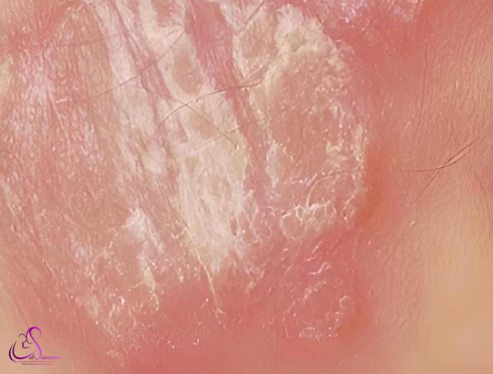 پسوریازیس لابیا