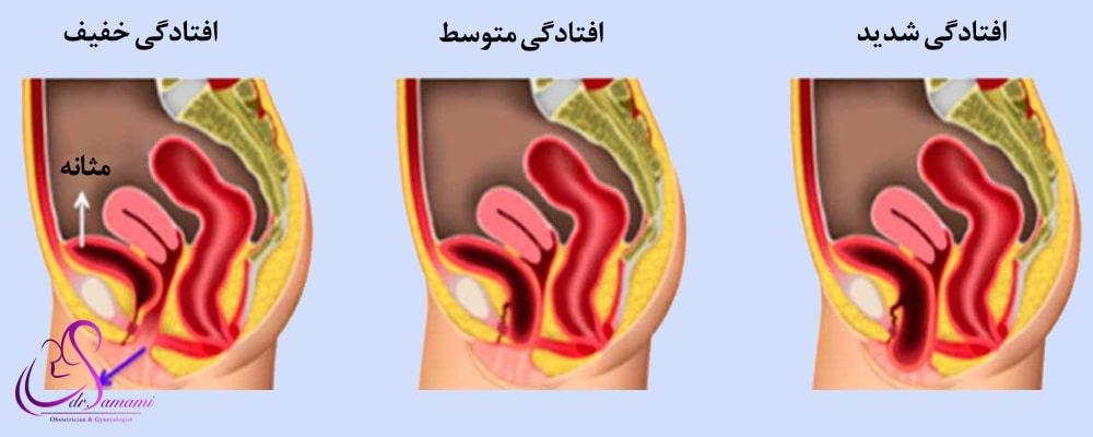 افتادگی مثانه