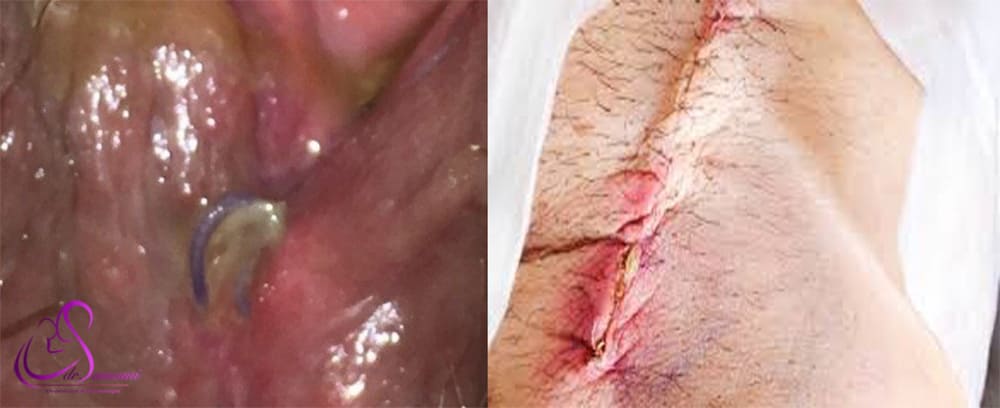 اسکار و عفونت جای بخیه