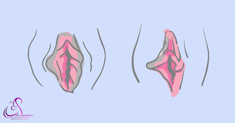 کشیدگی و عدم تقارن واژن