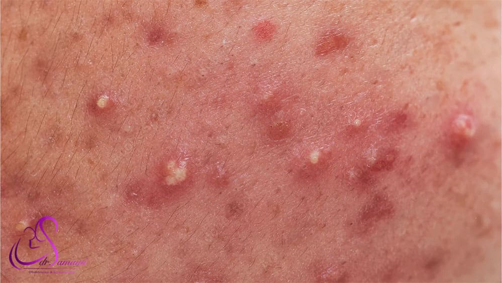 زینک اکساید برای افرادی که پوست حساس دارند مناسب نیست.