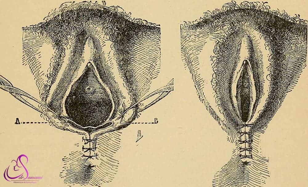 پرینوگرافی