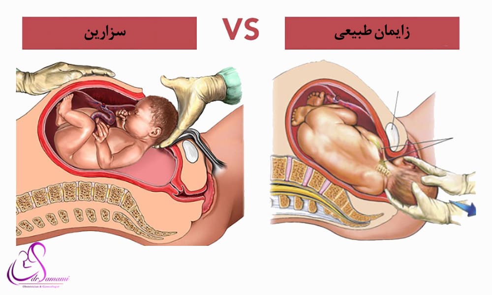 تفاوت زایمان طبیعی و سزارین