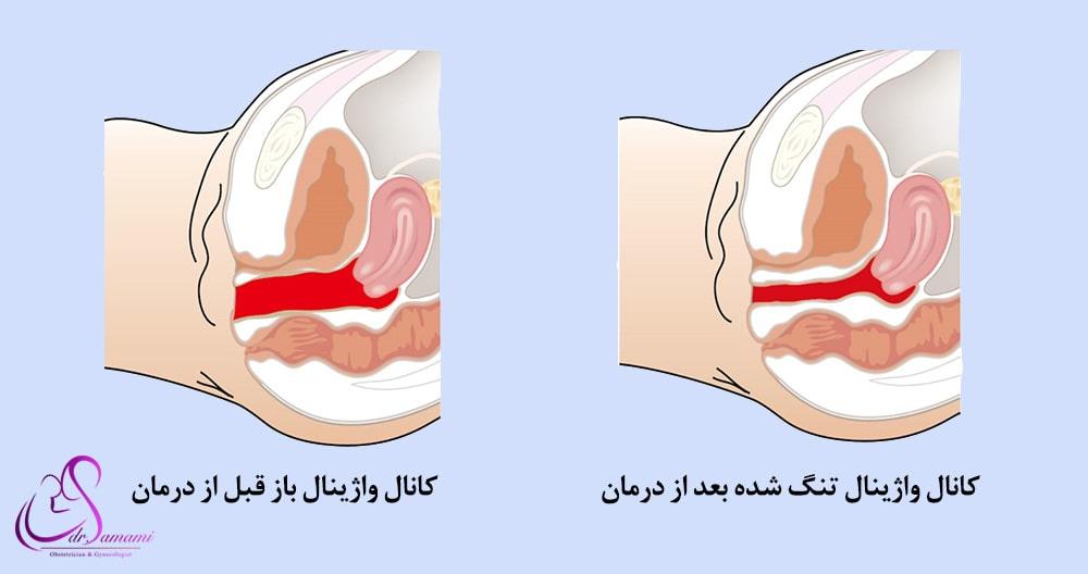 تنگ کردن واژن با لیزر