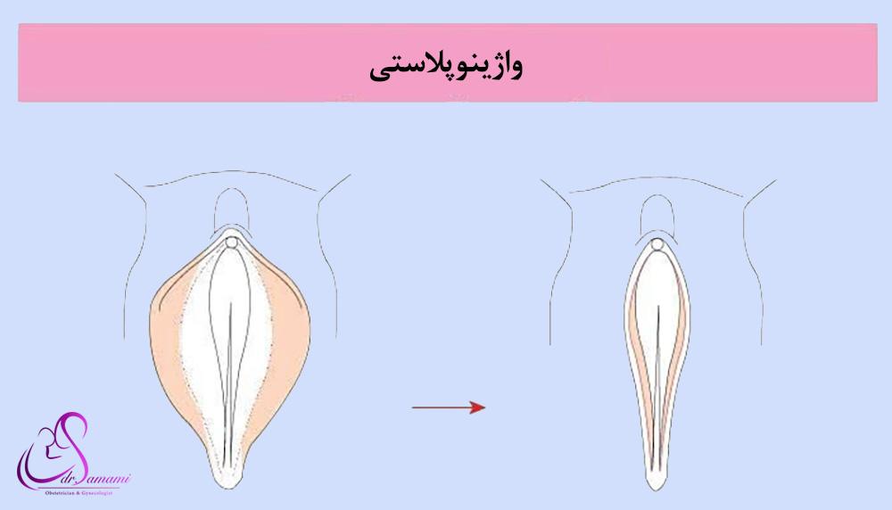 واژینوپلاستی