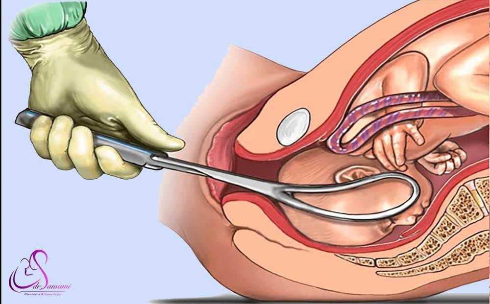 زایمان طولانی و پیچیده