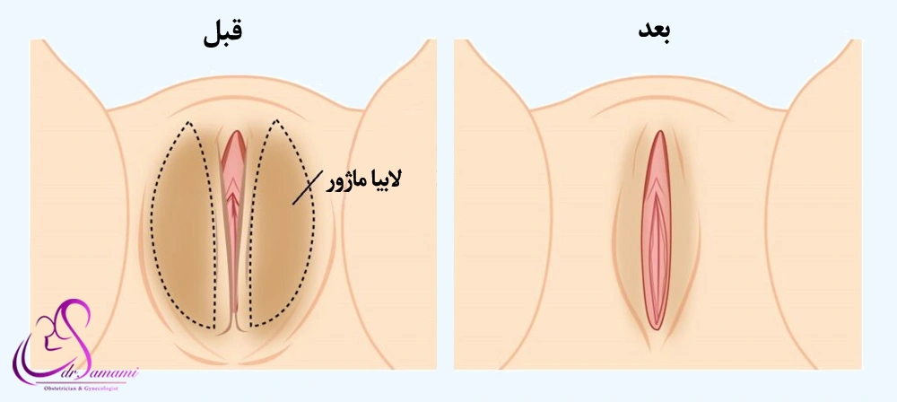 لابیاماژورپلاستی