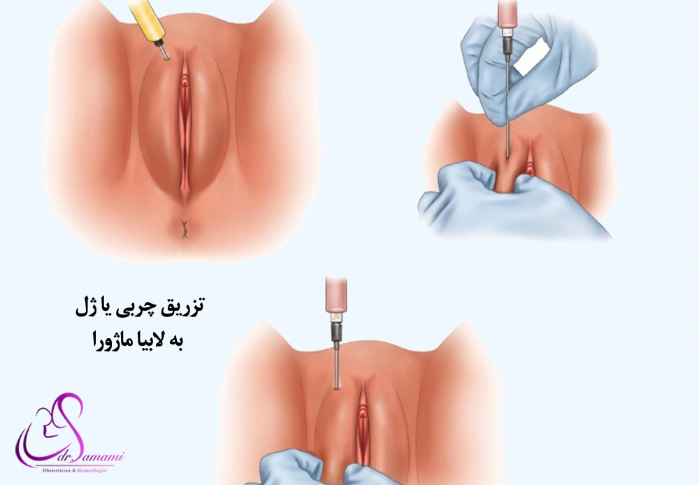 تزریق چربی یا ژل به لابیا ماژورا