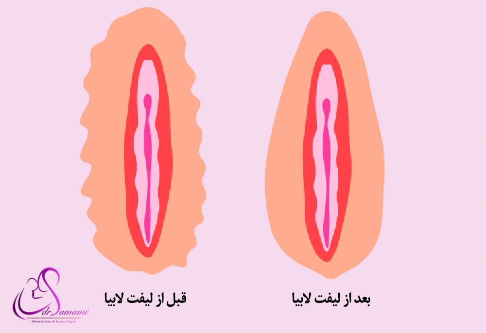 لیفت لابیا با اندولیفت