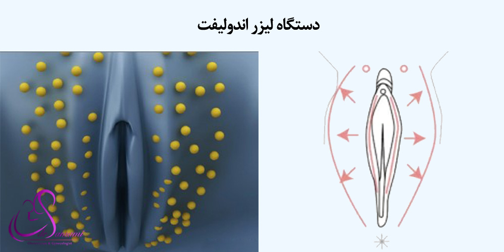 لیزرهای کم‌عمق